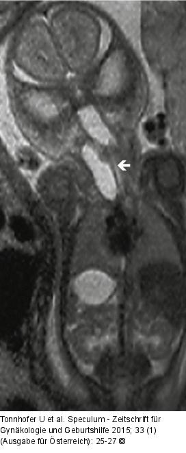 Pränataldiagnostik-Therapie