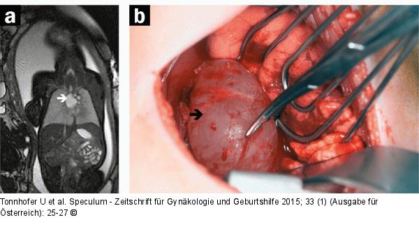 Pränataldiagnostik-Therapie