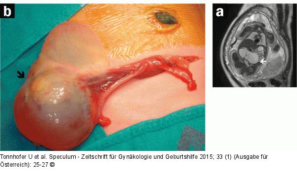 Pränataldiagnostik-Therapie
