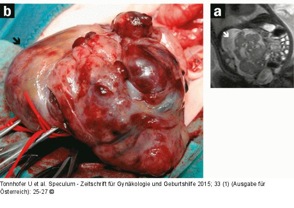 Pränataldiagnostik-Therapie