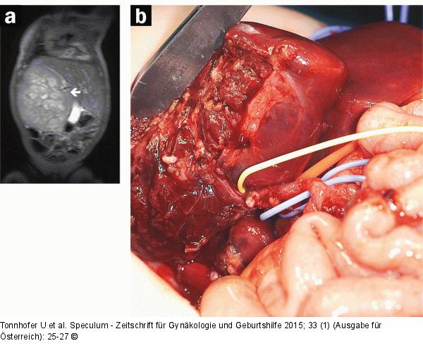 Pränataldiagnostik-Therapie