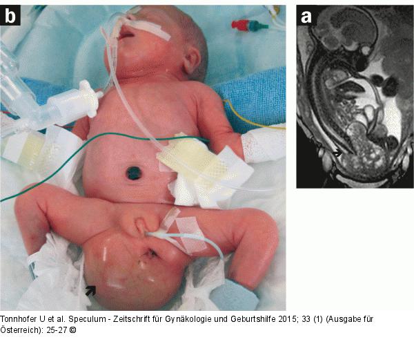 Pränataldiagnostik-Therapie