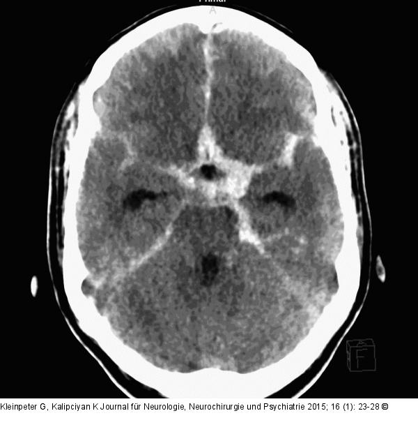 Subarachnoidalblutung