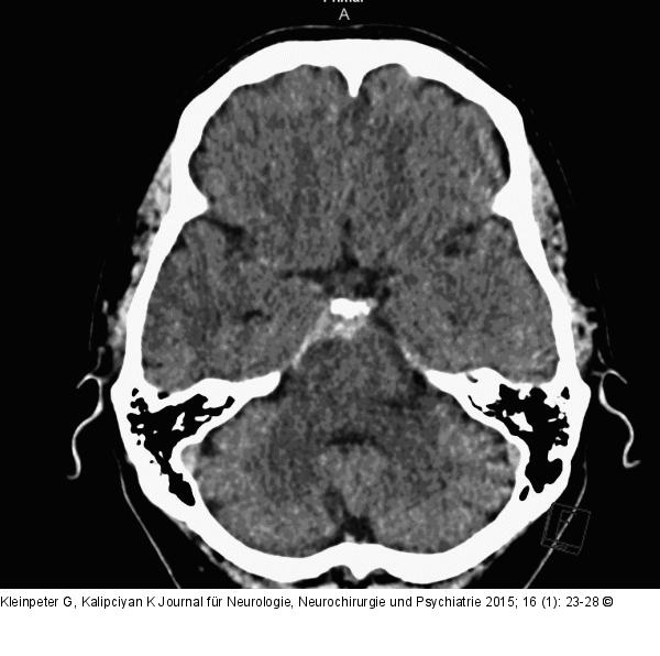 Subarachnoidalblutung
