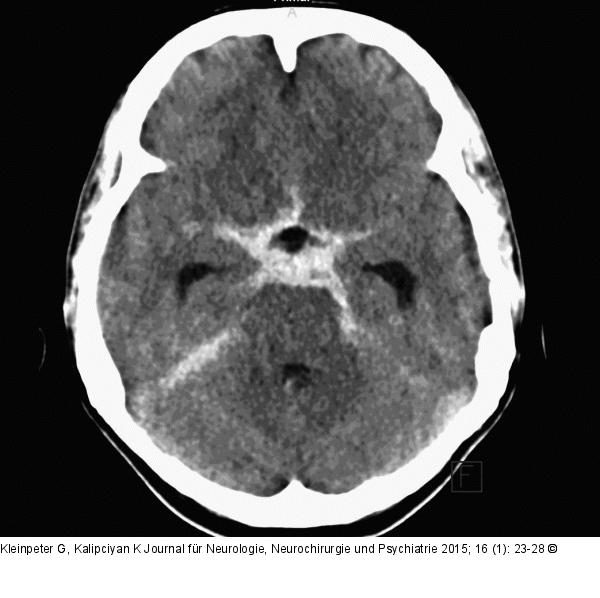 Subarachnoidalblutung