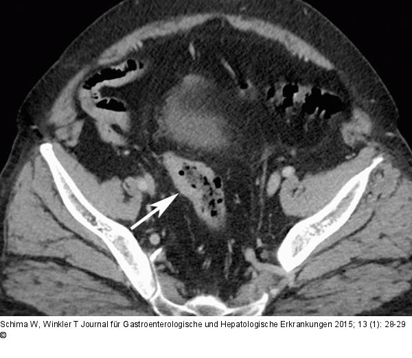 Intrapankreatische Nebenmilz
