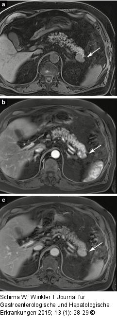 Intrapankreatische Nebenmilz