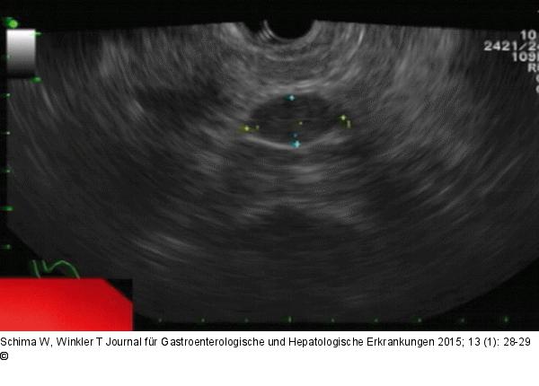 Intrapankreatische Nebenmilz