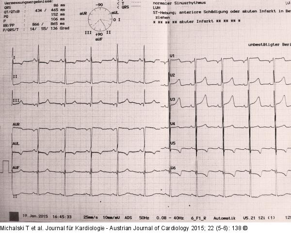 EKG - Normofrequenter Sinusrhythmus