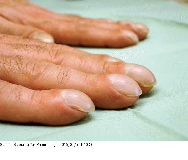 Respiratorische Bronchiolitis