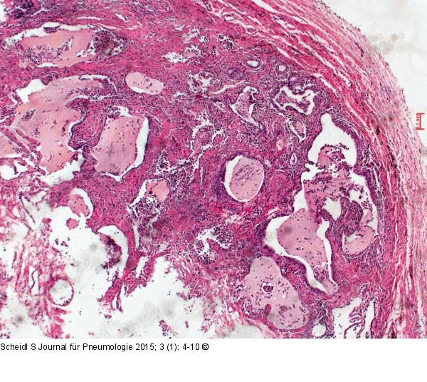 Trommelschlägelfinger