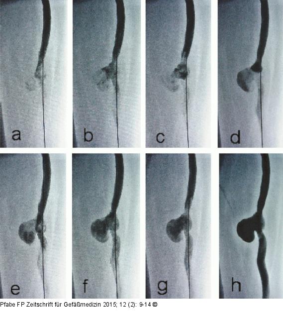 Pathologische Bypass-Hämodynamik