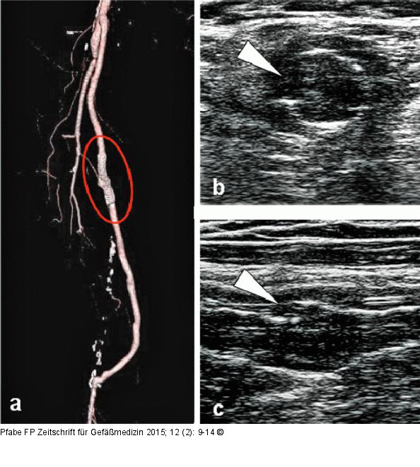 Stentfraktur Typ III