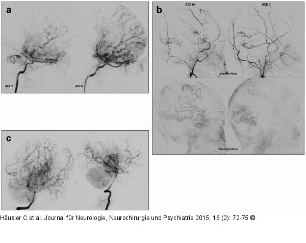 Moya-Moya-Erkrankung