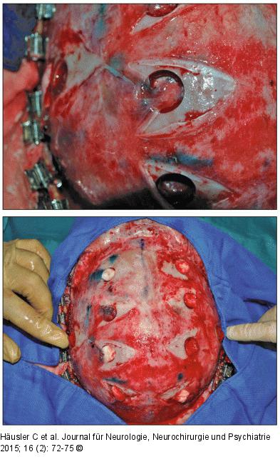 Moya-Moya-Erkrankung