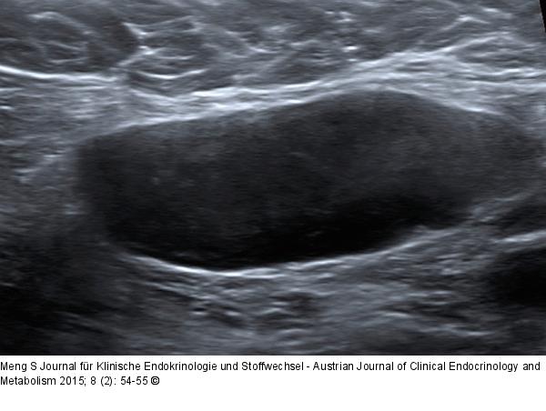 Ultraschall-Lymphknoten