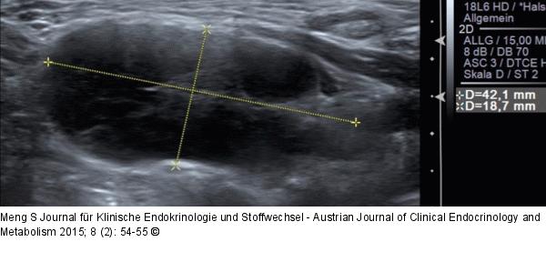 Ultraschall-Lymphknoten