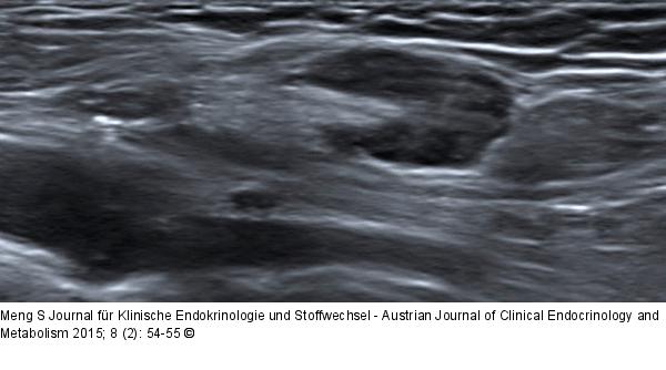 Ultraschall-Lymphknoten