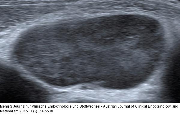 Ultraschall-Lymphknoten
