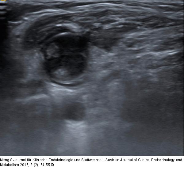 Ultraschall-Lymphknoten