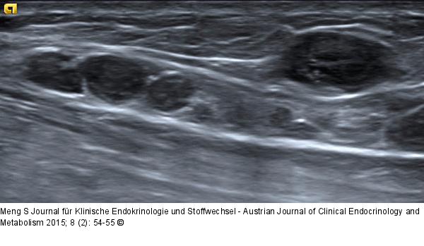 Ultraschall-Lymphknoten