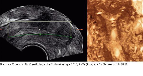 Ultraschall-Hormonspirale