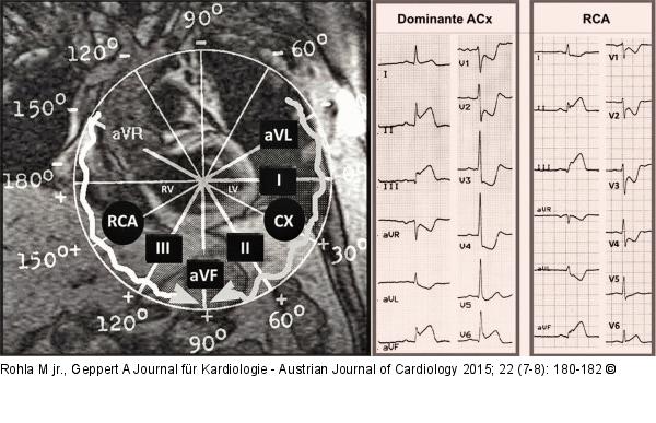 EKG-Beispiele - ST-T-Veränderungen
