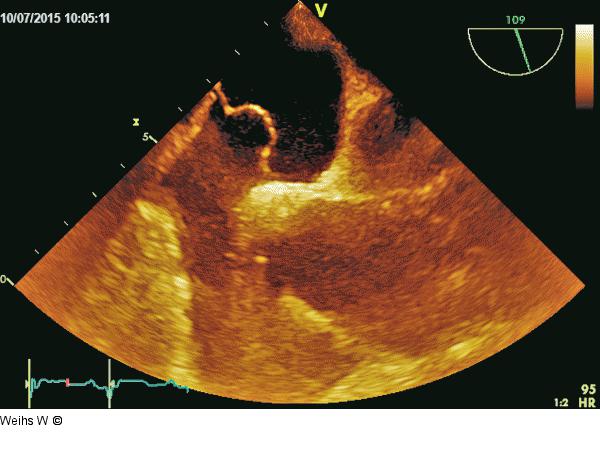 Vorhofseptumaneurysma