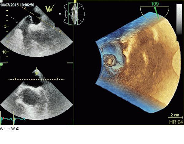 Vorhofseptumaneurysma