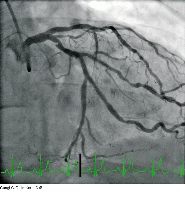 Proximale A. cricumlexa