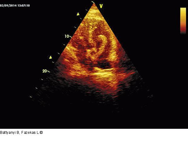 Apikaler Vierkammerblick