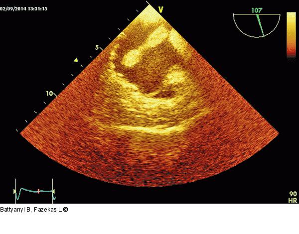 Thromboembolus