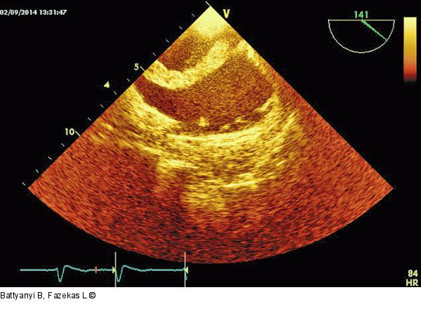 Thromboembolus