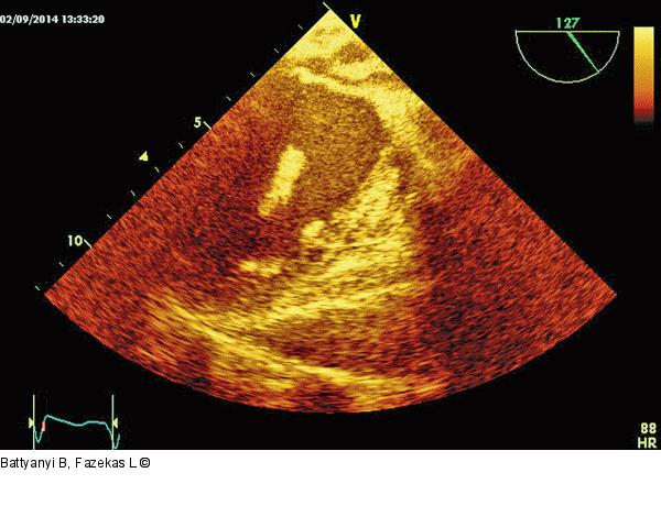 Thromboembolus