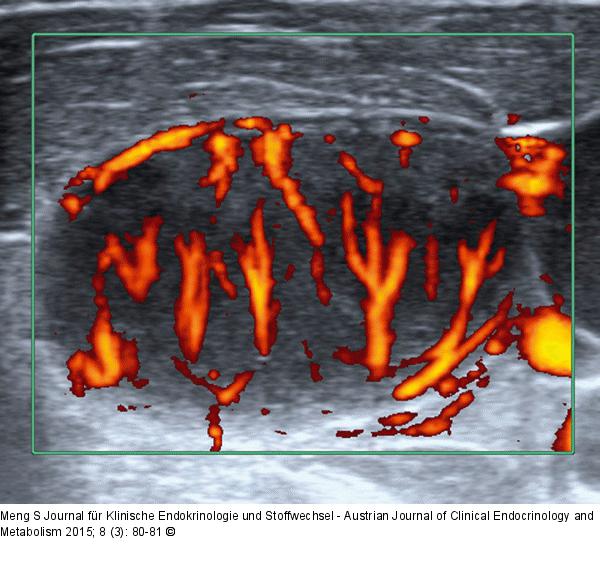 Lymphknoten-Ultraschall