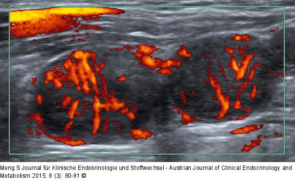 Lymphknoten-Ultraschall