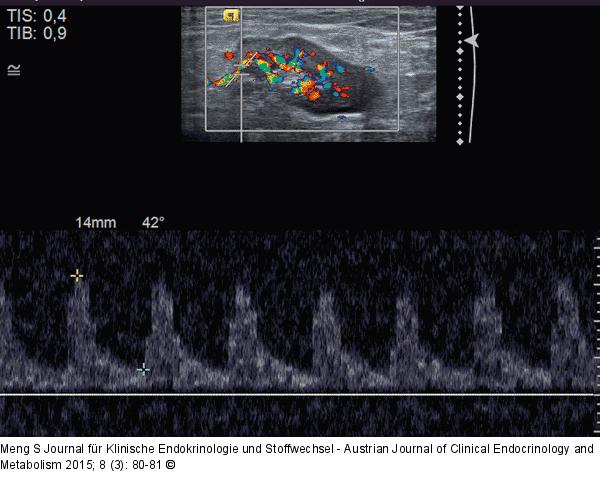 Lymphknoten-Ultraschall