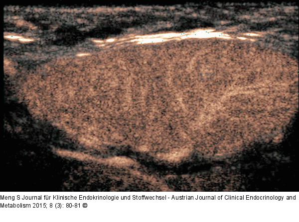 Lymphknoten-Ultraschall