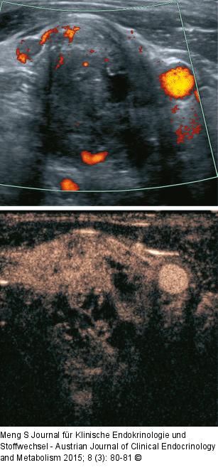 Lymphknoten-Ultraschall