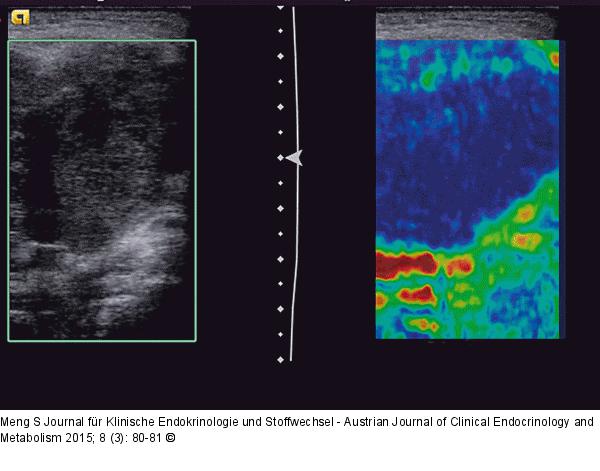 Lymphknoten-Elastographie