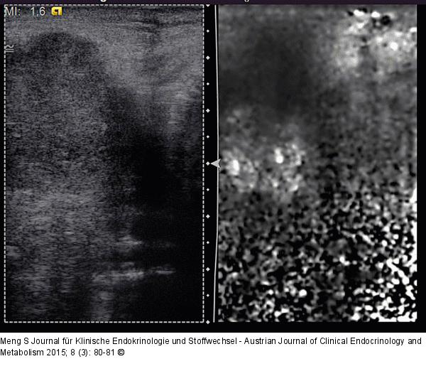 Lymphknoten-Elastographie