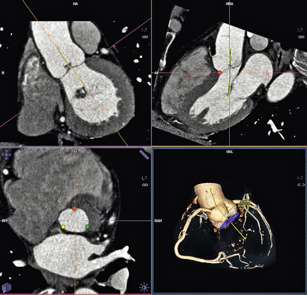 Produkt: TAVI<br>Vertrieb: Siemens AG