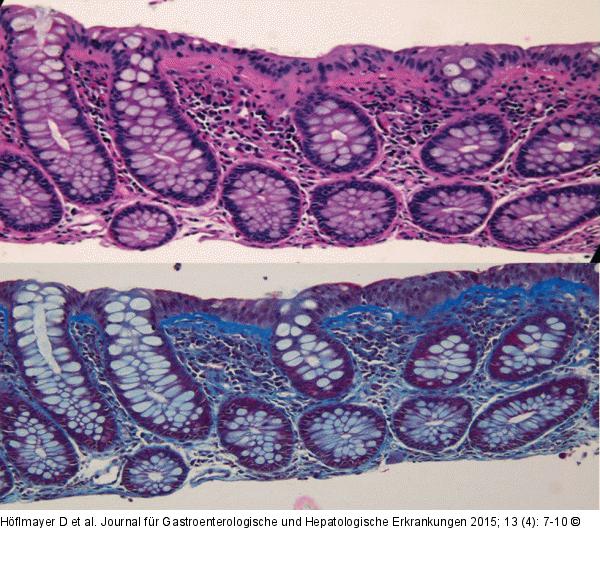 Eosinophiles Kollagenband
