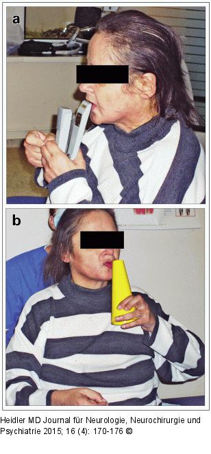 Limbische Enzephalitis