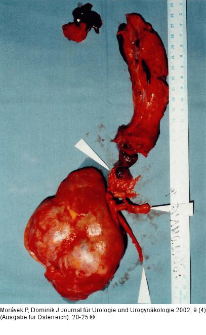 Nierenkarzinom - Tumorthrombose