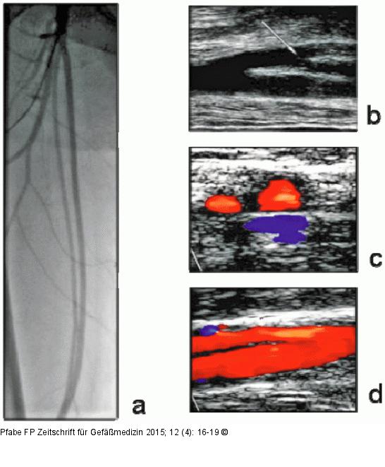 Arteria femoralis superficialis