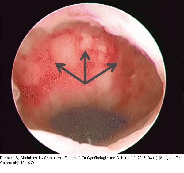 Uterotomie-Dehiszenz