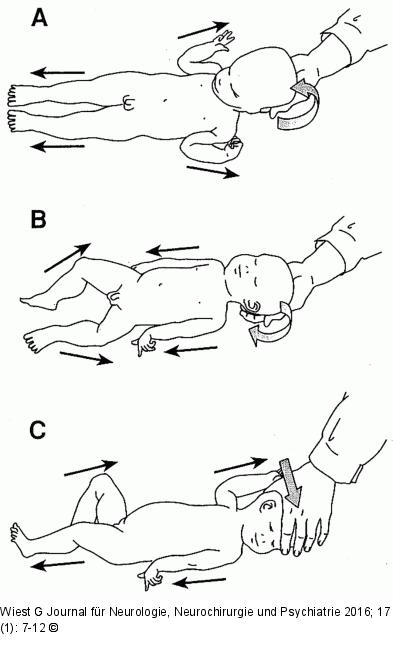 Nackenreflex-Säugling