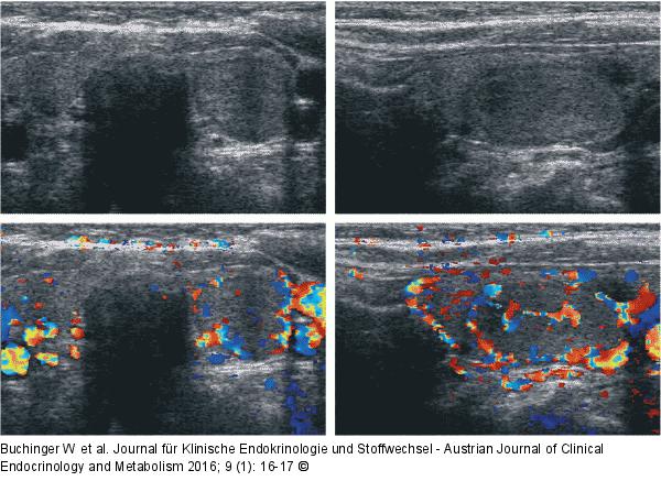 Knoten - Schilddrüse