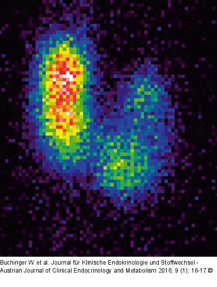 Knoten - Schilddrüse
